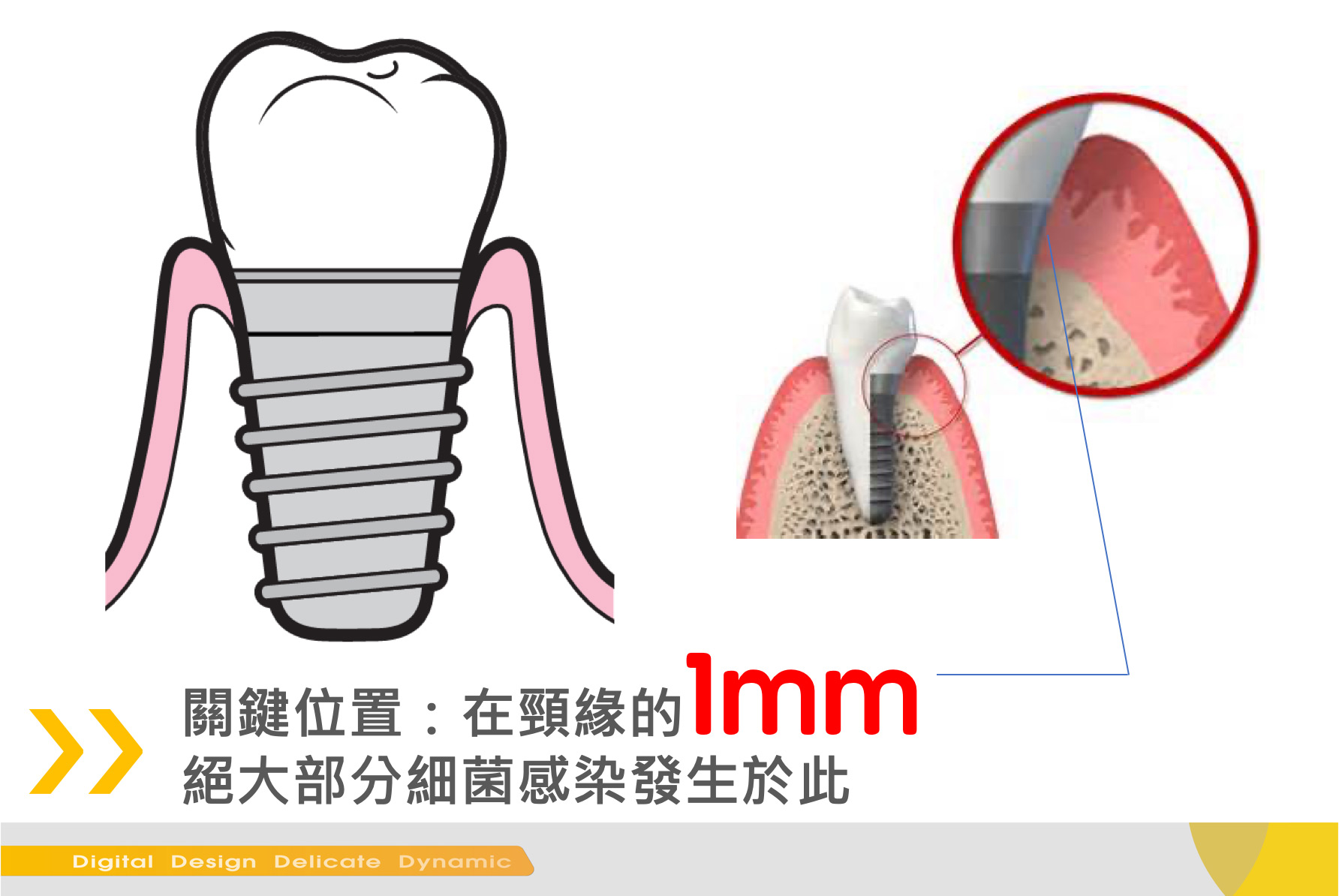 植體保養：1MM關鍵處